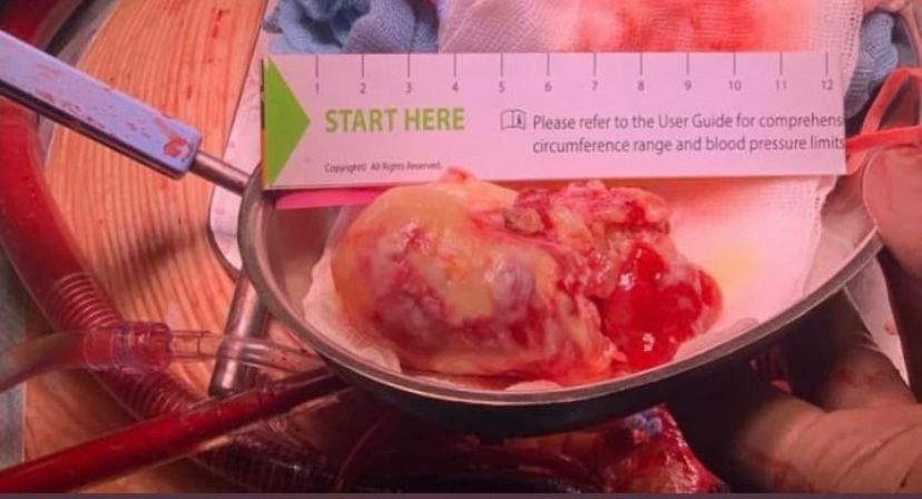В Челнах врачи извлекли 10-сантиметровую опухоль из сердца пациента