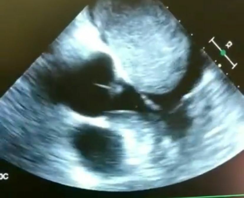 В Челнах врачи извлекли 10-сантиметровую опухоль из сердца пациента