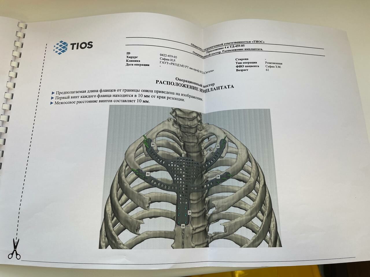 Впервые в Татарстане врачи заменили часть грудины и ребер на 3D-имплант