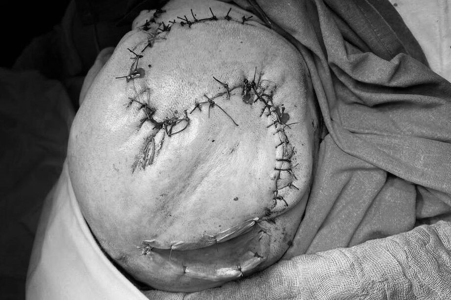 В Челнах врачи БСМП удалили 10-сантиметровую опухоль пожилой пациентке
