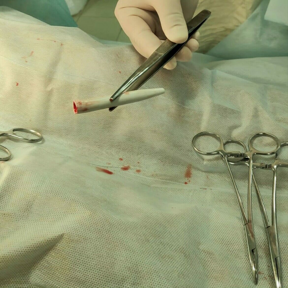 Врачи Набережных Челнов извлекли ручку из полового органа молодого пациента