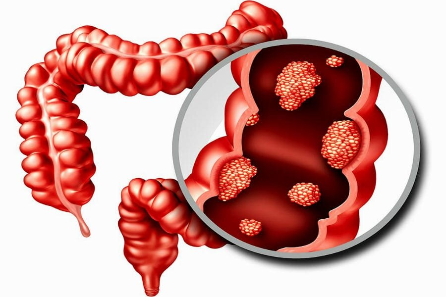 Колоректальный рак является одним из наиболее часто встречаемых онкологических заболеваний