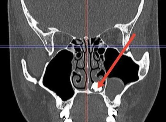 Врачи нашли молочный зуб в носу жителя Подмосковья