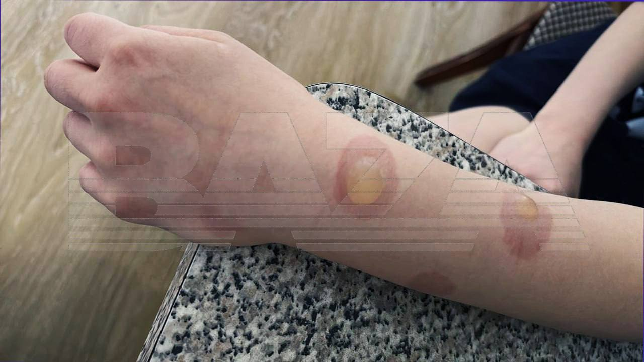 Школьники получают ожоги от дезодоранта: опасный тренд из TikTok