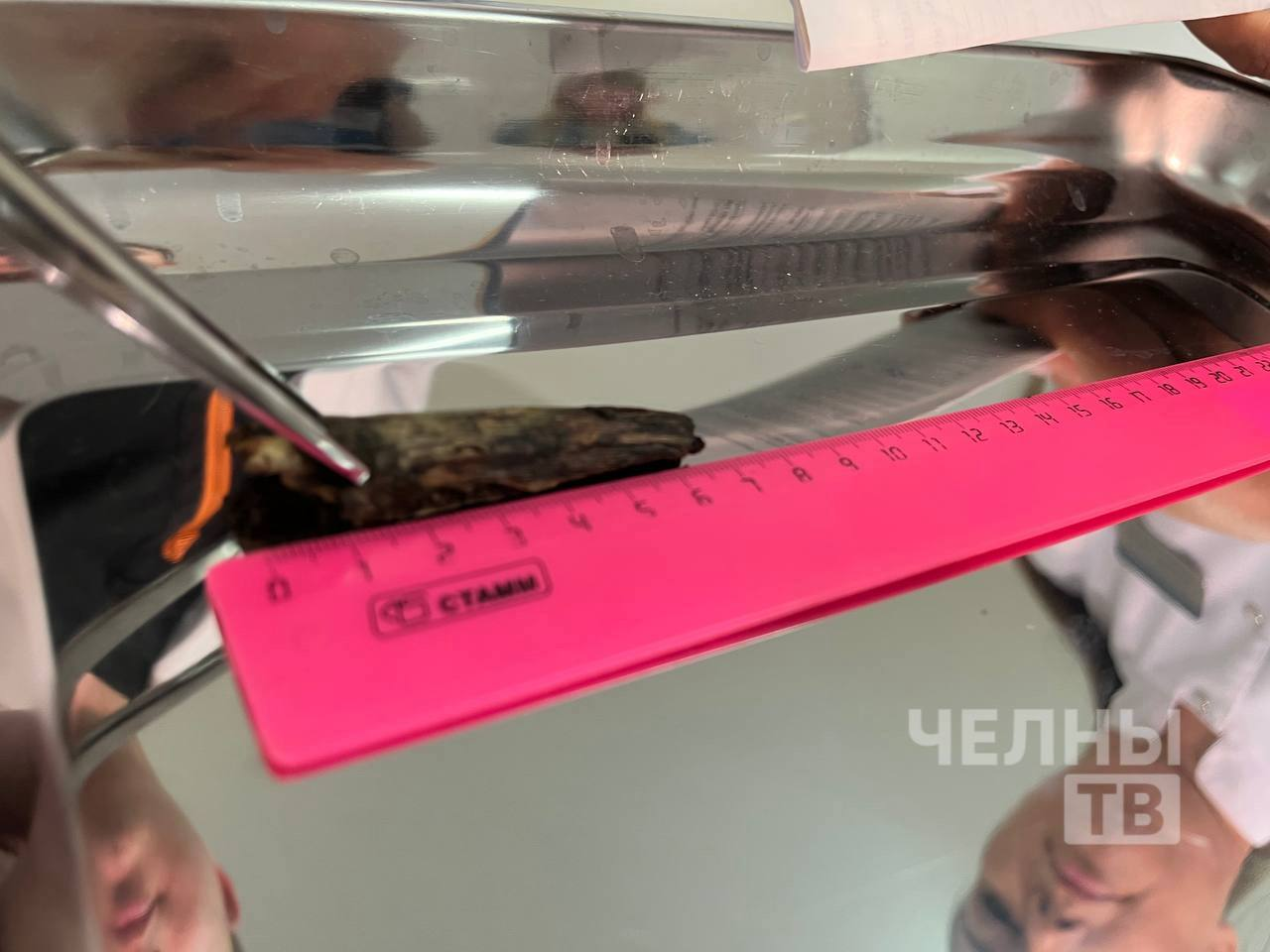 Рыбак из Челнов выжил после того, как ветка пробила глаз и дошла до черепа