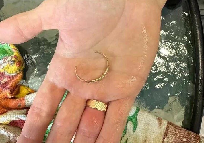 В Казани МЧС сняли кольцо с пальца молодой мамы после отека