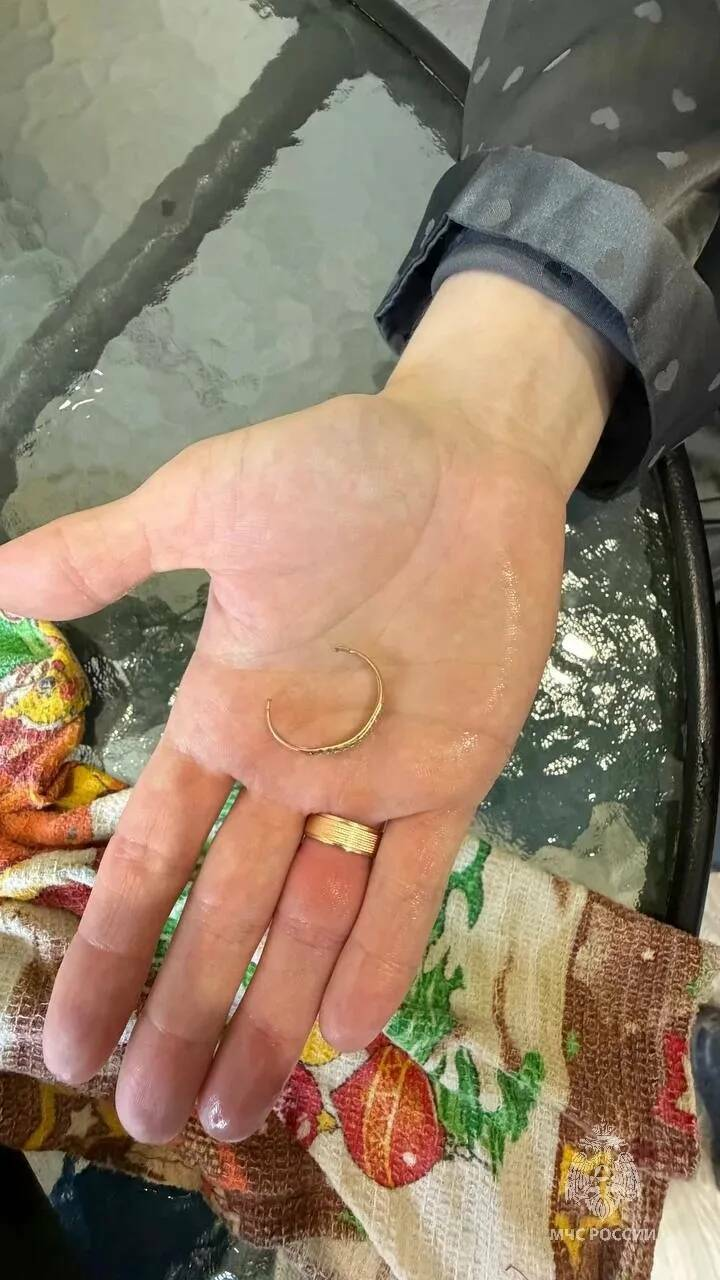 В Казани МЧС сняли кольцо с пальца молодой мамы после отека