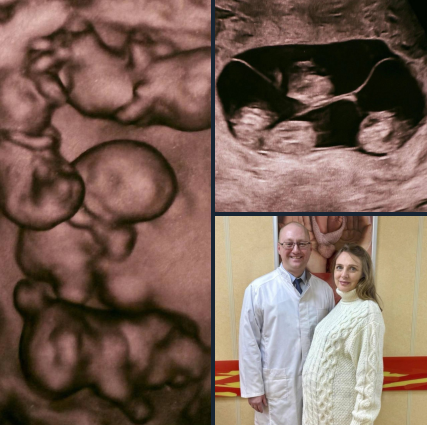 В России родилась однояйцевая четверня — редчайший случай