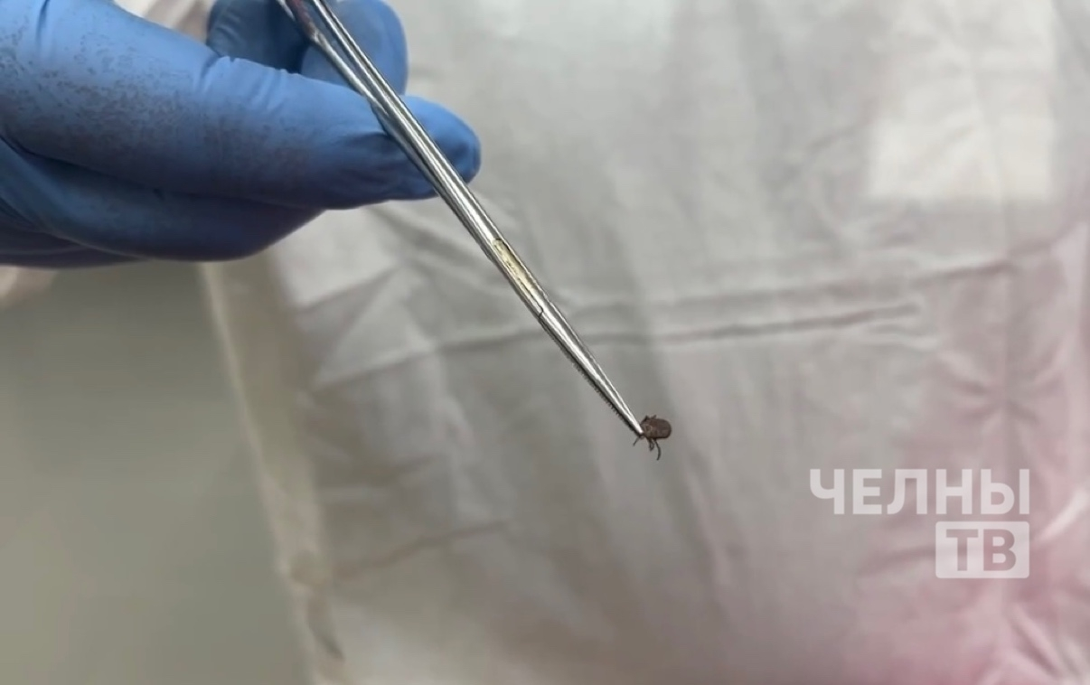 В Челнах зафиксировали три случая укуса клеща среди детей