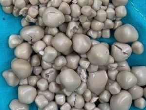 У девушки из Тайваня удалили 300 камней из-за отказа от воды