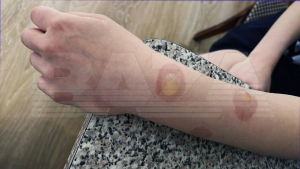 Школьники получают ожоги от дезодоранта: опасный тренд из TikTok