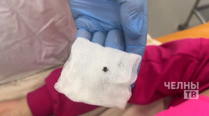 В Челнах зафиксировали три случая укуса клеща среди детей